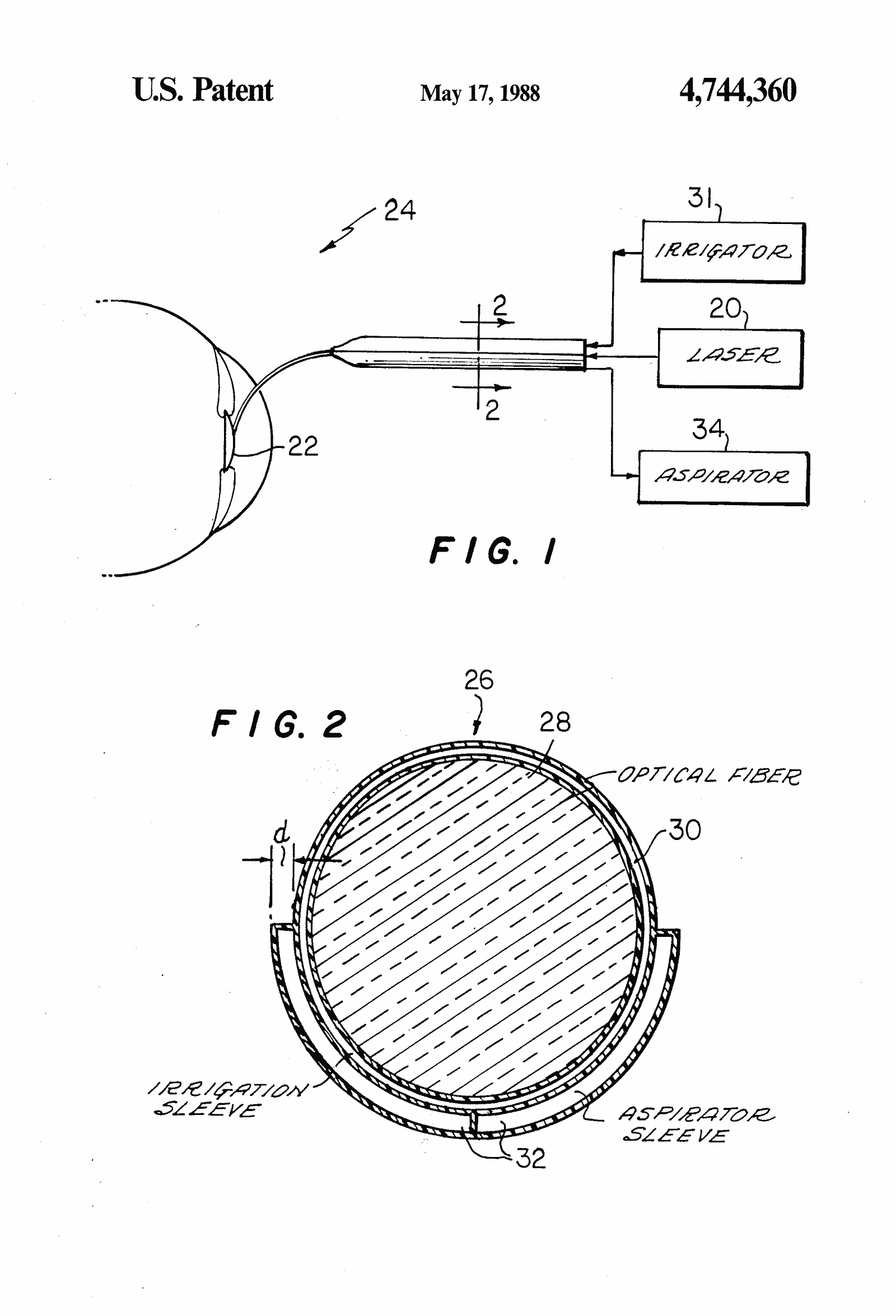 Original patent drawing for "Apparatus for ablating and removing cataract lenses", U.S. Patent 4,744,360 (1988)